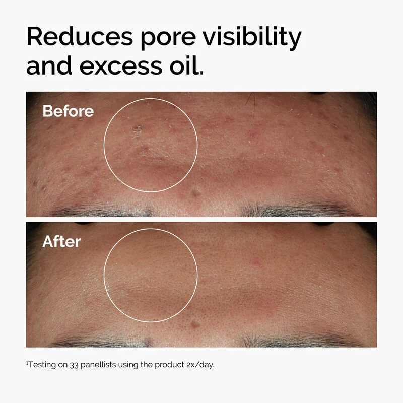 Before and after using The Ordinary Niacinamide 10% + Zinc 1%