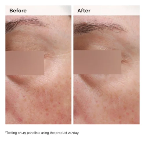 Visible skin texture results with The Ordinary Niacinamide 5% Face and Body Emulsion