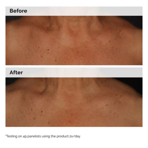 Visible skin tone results with The Ordinary Niacinamide 5% Face and Body Emulsion