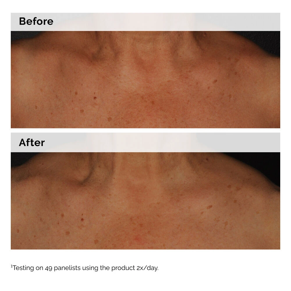 Visible skin tone results with The Ordinary Niacinamide 5% Face and Body Emulsion