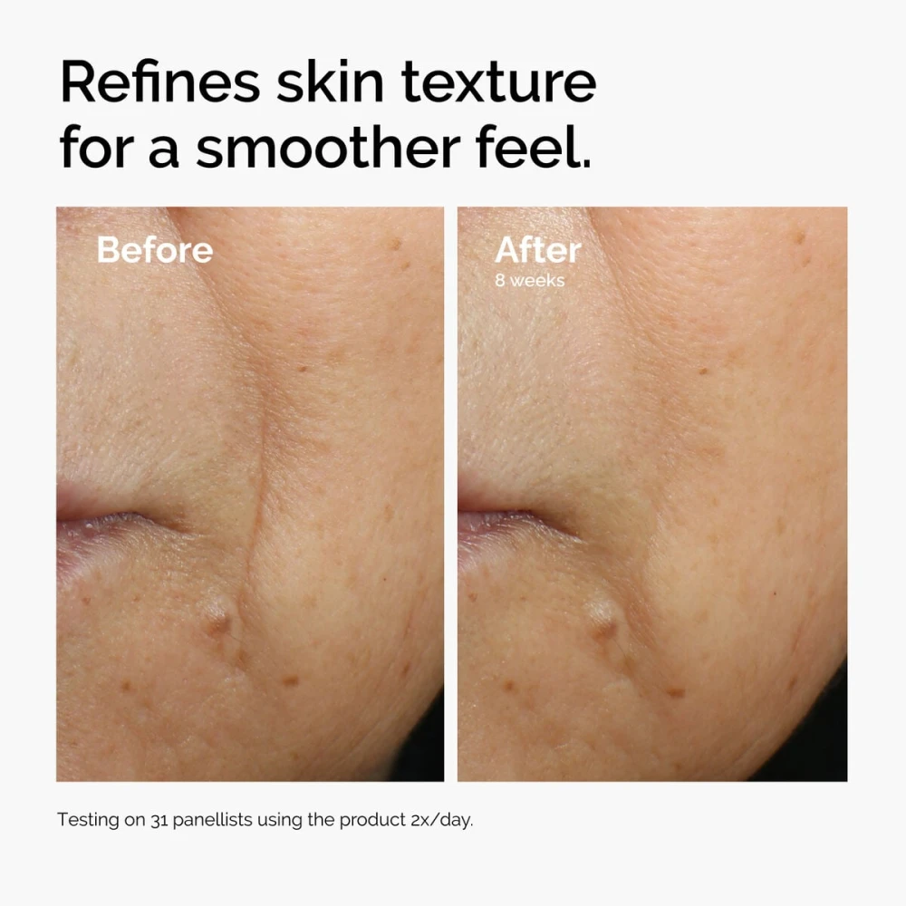 Skin texture before and after using The Ordinary Caffeine + Escin Face Serum