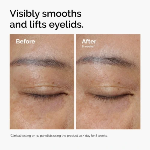 Eyelid lifting results after 8 weeks with The Ordinary Lacto-PDRN 4% + B9 Eye Cream