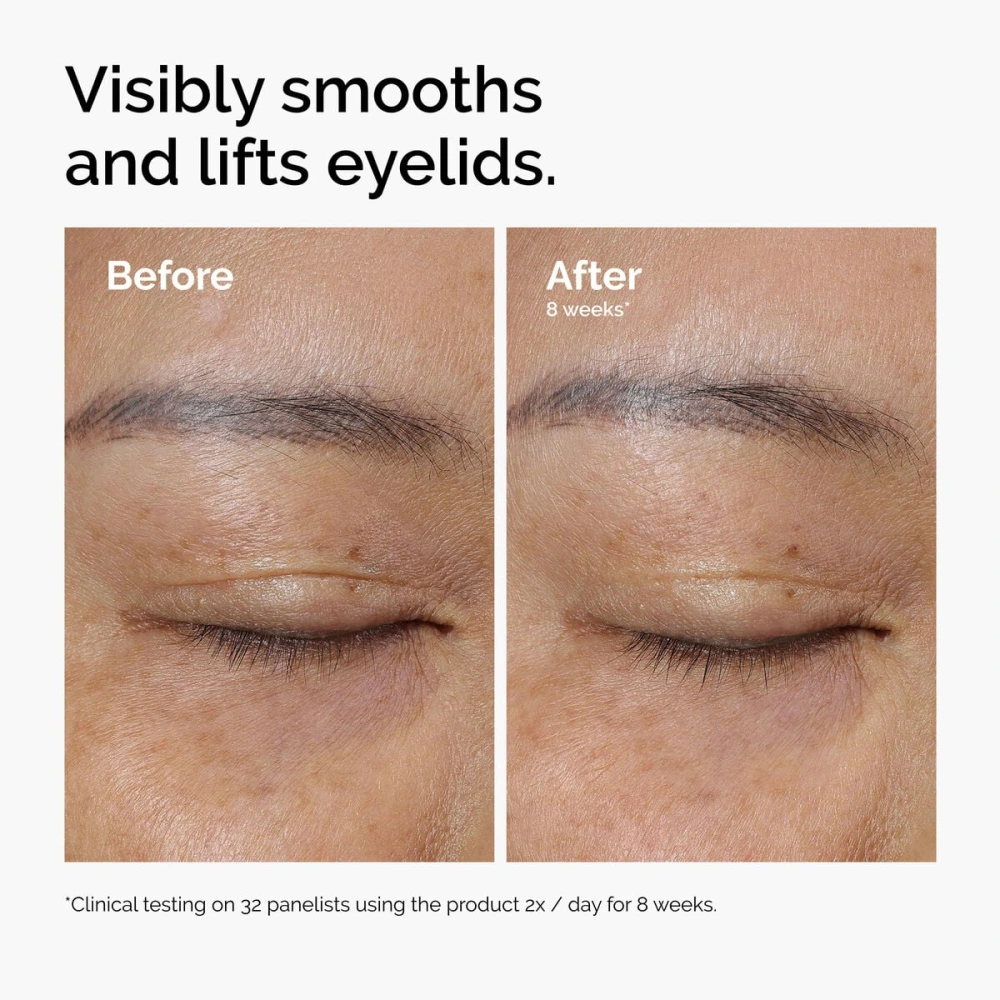 Eyelid lifting results after 8 weeks with The Ordinary Lacto-PDRN 4% + B9 Eye Cream