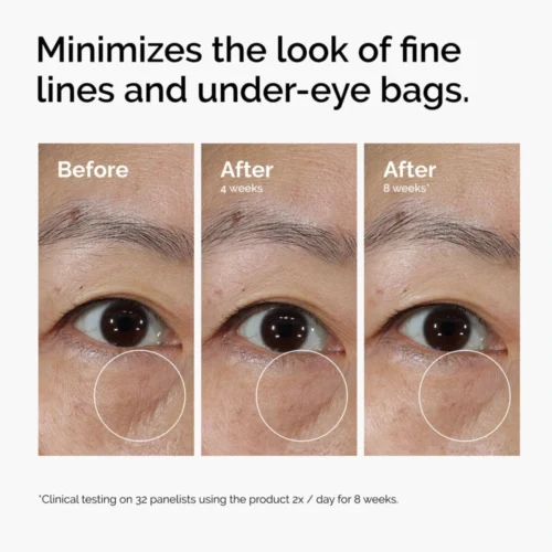 Fine lines and eye bags before, after 4 weeks and after 8 weeks of using The Ordinary Lacto-PDRN 4% + B9