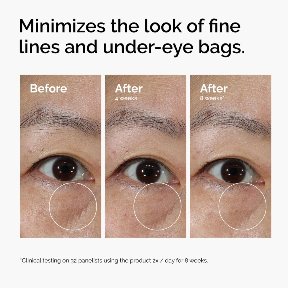 Fine lines and eye bags before, after 4 weeks and after 8 weeks of using The Ordinary Lacto-PDRN 4% + B9