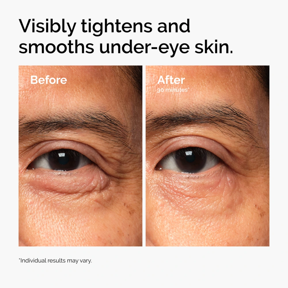 Eye area before and 30 minutes after The Ordinary Lacto-PDRN 4% + B9 Eye Cream